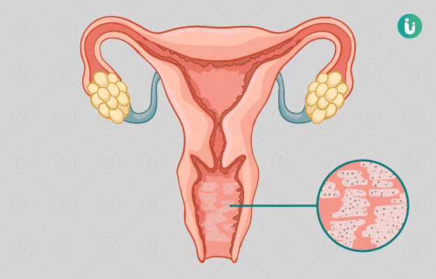 Understanding the Signs: Is It Bacterial Vaginosis?